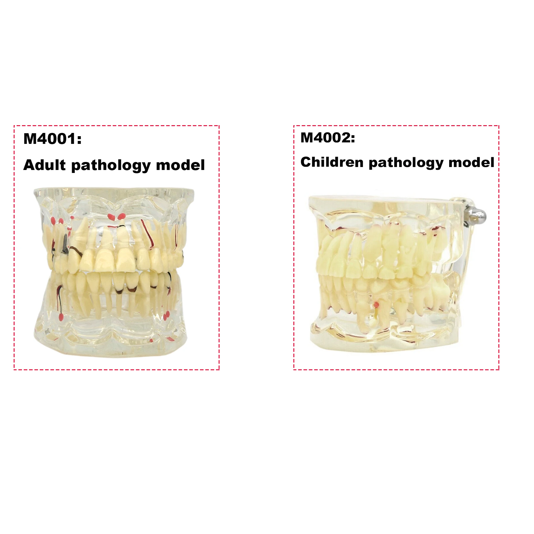 Dental Model  Pathology Teeth Model Children Carious Cysts model For Student Training