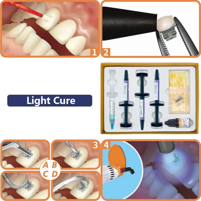 Dental Kieferorthopädische Klebstoff Selbst/Licht Heilung Kleber Kit für Orthodontia Hosenträger Klammern Blau Kleber Zahnmedizin Direkten Verkleben