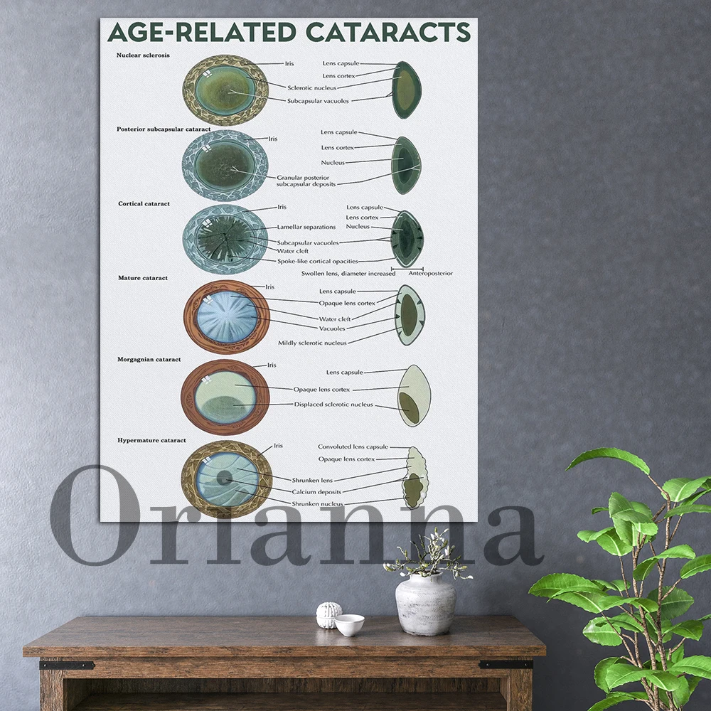 Eye Related Poster Cataract Awareness Wall Art Eye Health Decor Eye Disease Anatomical Chart Art Print Retro Canvas Painting