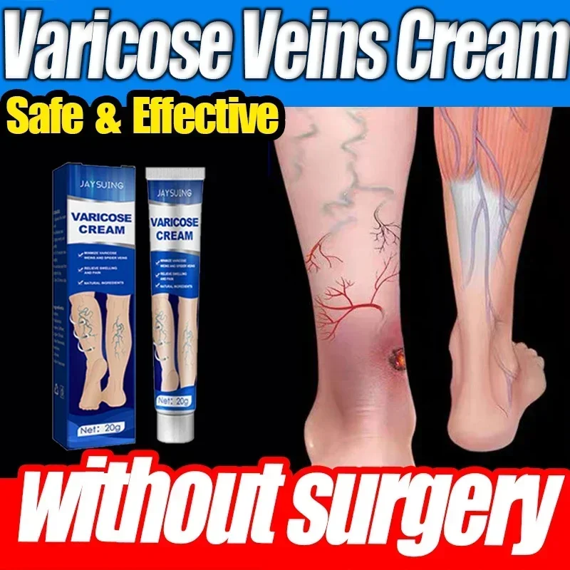 

Varicose Vein Repair Cream Effective Relieves Leg Bulge Pain Treatment Ointment Vasculitis Phlebitis Remove Vein Plaster