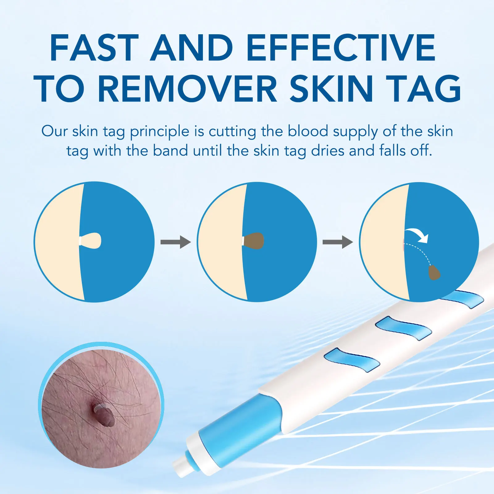 Home Use Painless Safe Skin Tag Mole Wart Spot Removal Equipment for Smooth Skin Wart Remover Eyelid Lifting Acne Treatment Pen