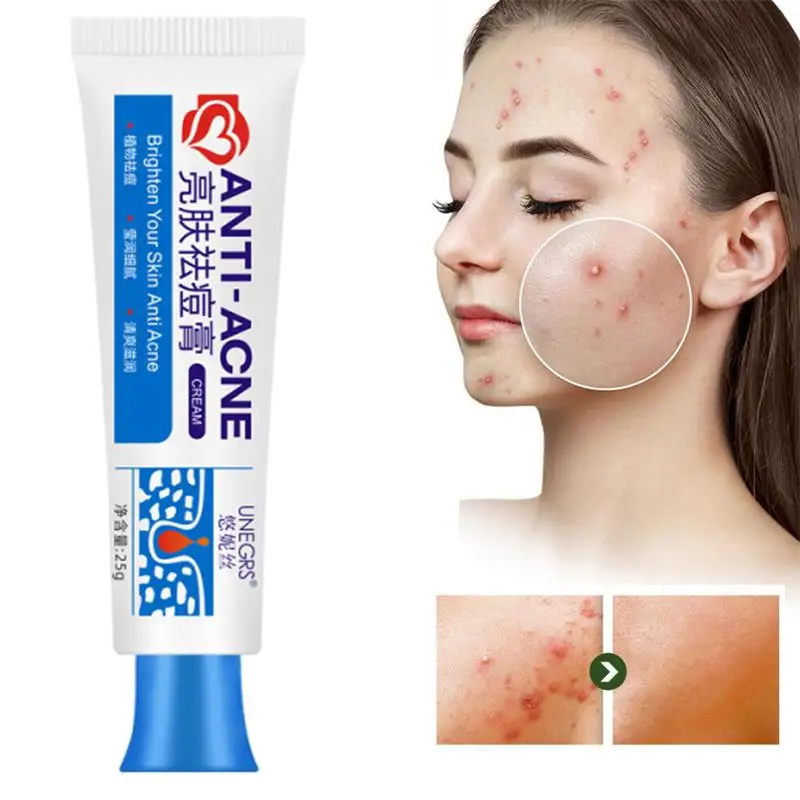 Crema facial a base de hierbas para eliminar el acné, elimina las cicatrices de los granos y los puntos negros, gel para el tratamiento del acné, reduce los poros, aclara y blanquea la piel.