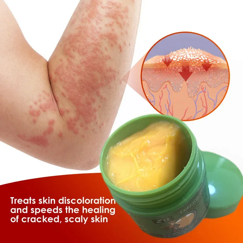 Dermatitis Eczematoid Treatment Antibacterial Ointment Herbal Psoriasis Cream Effective Body Anti-Itch Health Skin Care Product