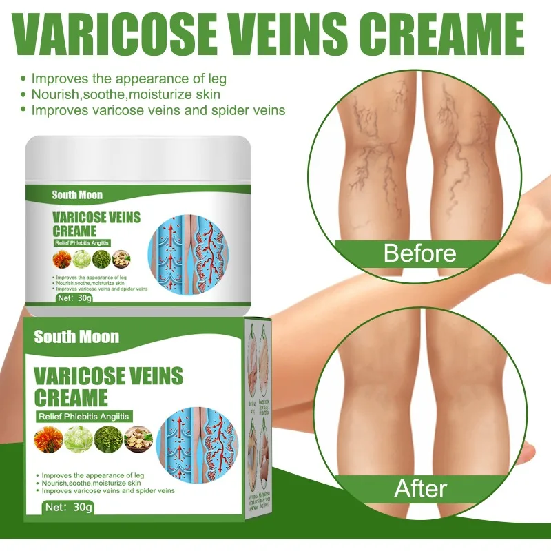 Crema per la rimozione delle vene Varicose efficace allevia il rigonfiamento delle gambe riparazione del trattamento del dolore elimina la vasculite flebite cura del corpo naturale