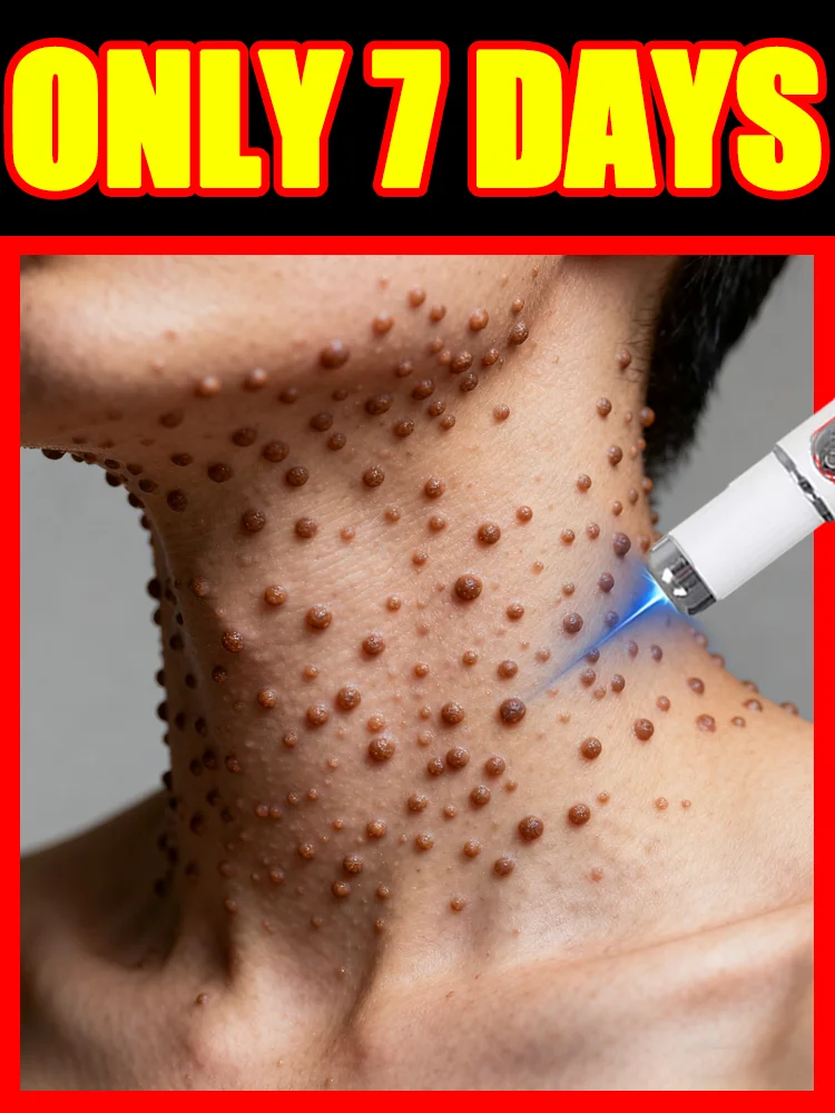 [Nowość 2025] Bezproblemowe usuwanie brodawek, długopis z niebieskim światłem na brodawki, darmowa wysyłka, narzędzia do pielęgnacji brodawek, Najlepszy Sprzedawca