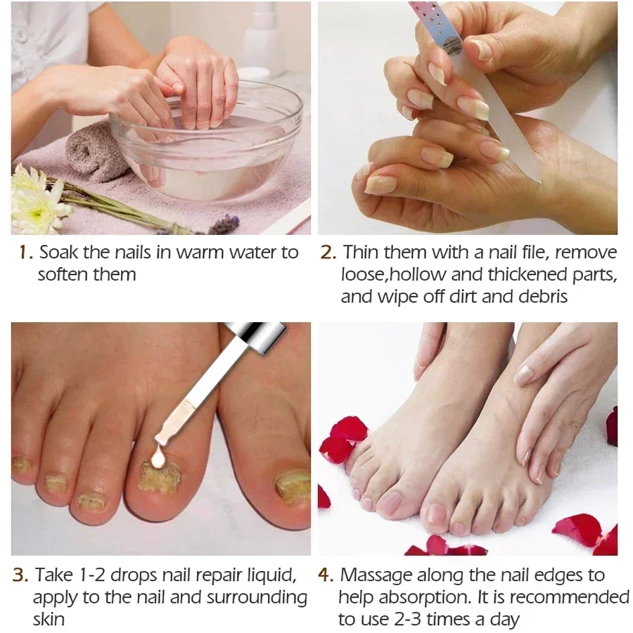 ⁿⁱᶜᵉ Fungal Nail Treatment Essence Oil Nail Fungus Repair Toenail Fingernail Treatment Onychomycosis with Mushrooms