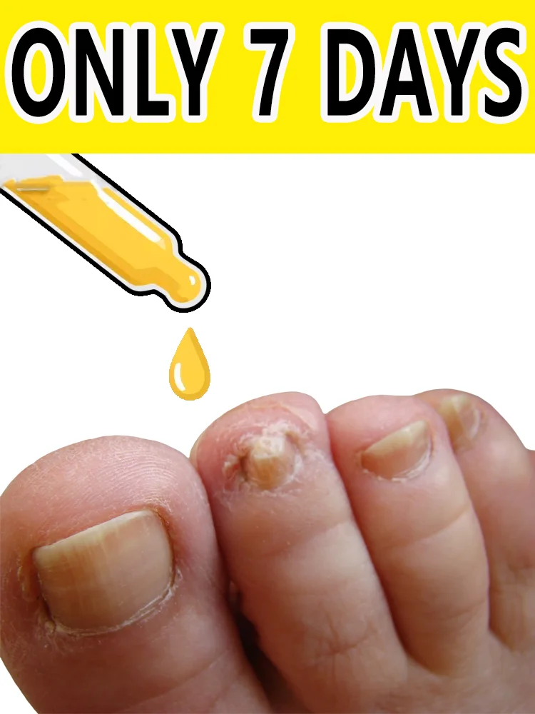 

Мягко проникает устраняет грибку и восстанавливает здоровые ногти.