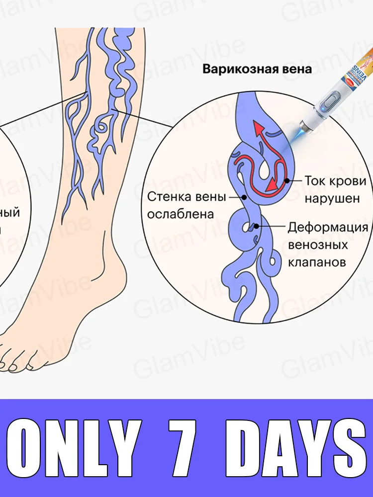 

blue light pen solve varicose veins, hot sale leg care tools
