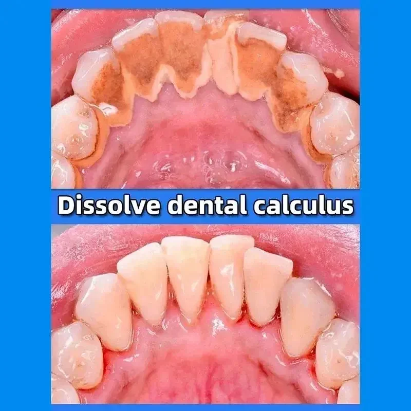 Eliminador de cálculo Dental, eliminación de blanqueamiento, mal aliento, pasta de dientes, brillo, previene la periodontitis, cuidado de limpieza Dental