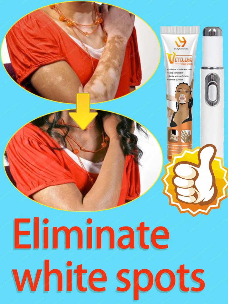 

Effective treatment for vitiligo~