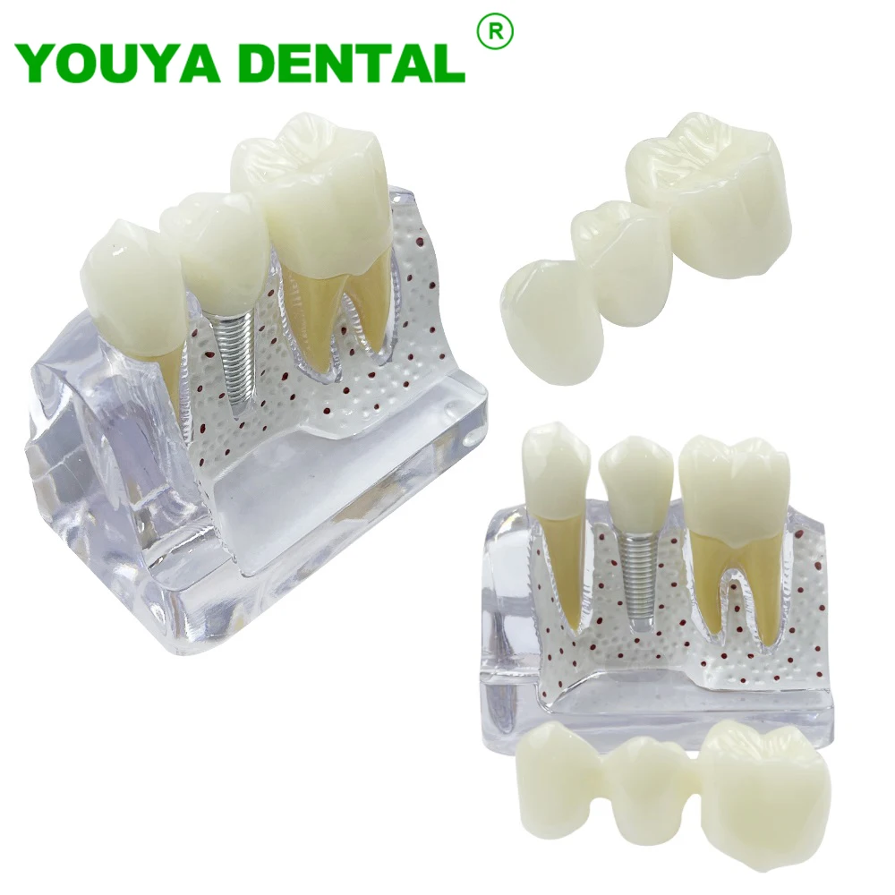 4 Times Dental Teach Implant Analysis Crown Bridge Removable Model Dentistry Demonstration Teeth Model Medical Science Study