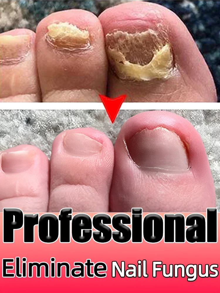 Foot Nail troubles Solved completely