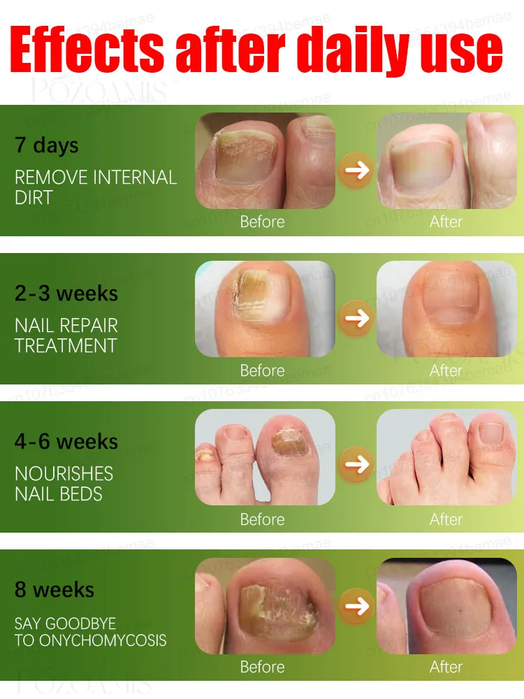 Dᴇᴇᴘ ɪɴᴛᴏ ᴛʜᴇ ɴᴀɪʟ ʙᴇᴅ, ʀᴇᴍᴏᴠᴇ ʙᴀᴄᴛᴇʀɪᴀ ᴀɴᴅ ᴍᴀᴋᴇ ɴᴀɪʟs ʜᴇᴀʟᴛʜʏ