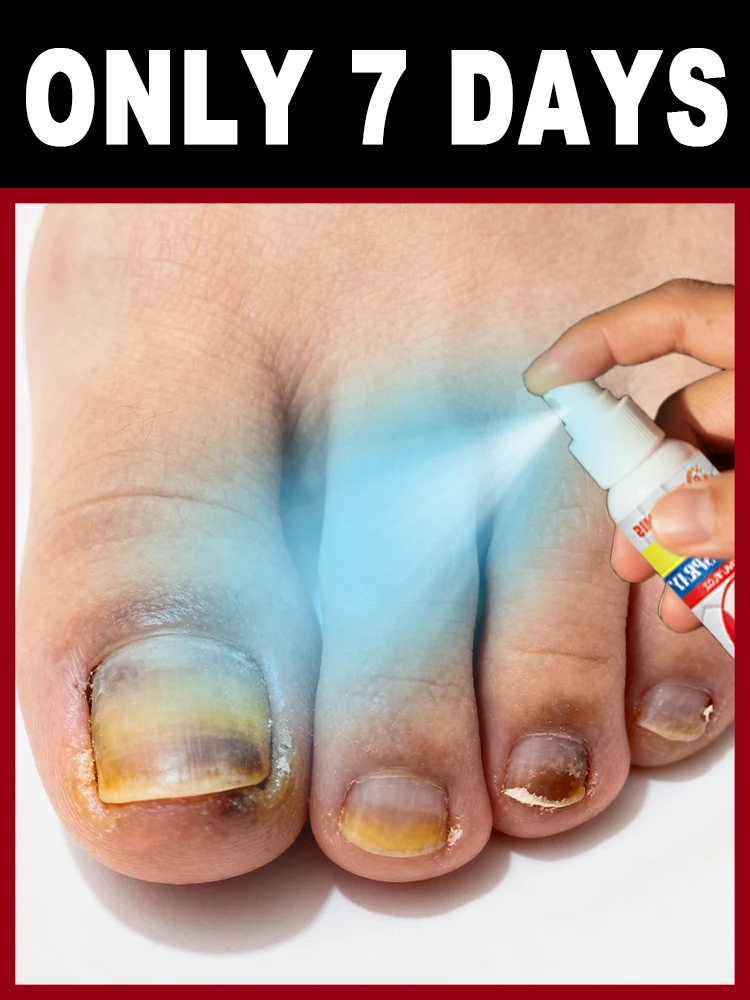 This nail spray can not only remove bacteria and gray nails, ᵇᵘᵗ ᵃˡˢᵒ ᶠᵒʳᵐ ᵃ ᵖʳᵒᵗᵉᶜᵗⁱᵛᵉ ˡᵃʸᵉʳ