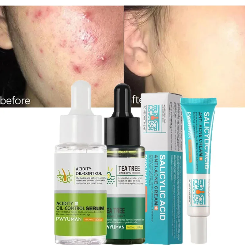 

Salicylic Acid Acne Treatment Cream Repair Pimple Spots Serum Cleaning Pore Anti-acne Oil Control Moisturizer Smooth Skin Care