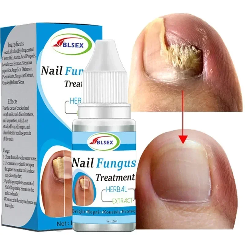 

Nail Repair Solution Fungus Nails Treatment For Fingernails Toenails Repair Onychomycosis Paronychia Anti Infection Toe Nail New