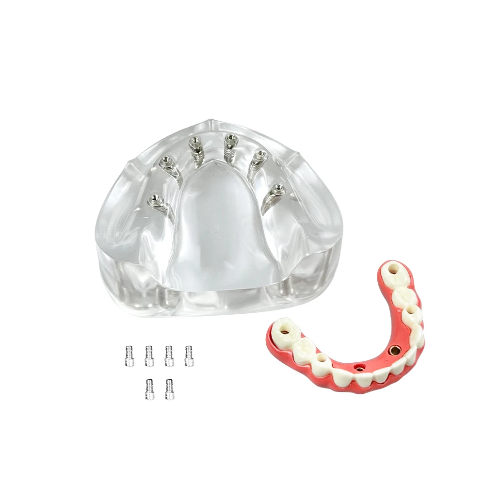 

Dental Lower Tooth Implant Model 6 Implants Low Jaw Maryland Bridge Teeth Models for Researching Medical Teaching Studying