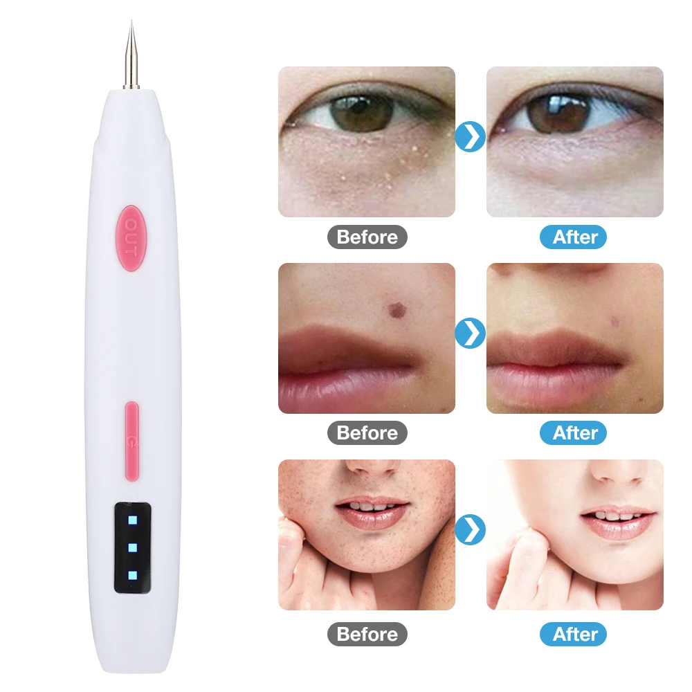Mini Mol Pen Elektrische Beauty Spot Pen Verwijder Molvlekken Wratten Vetkorrels Tatoeages Remaval Tool Schoonheid