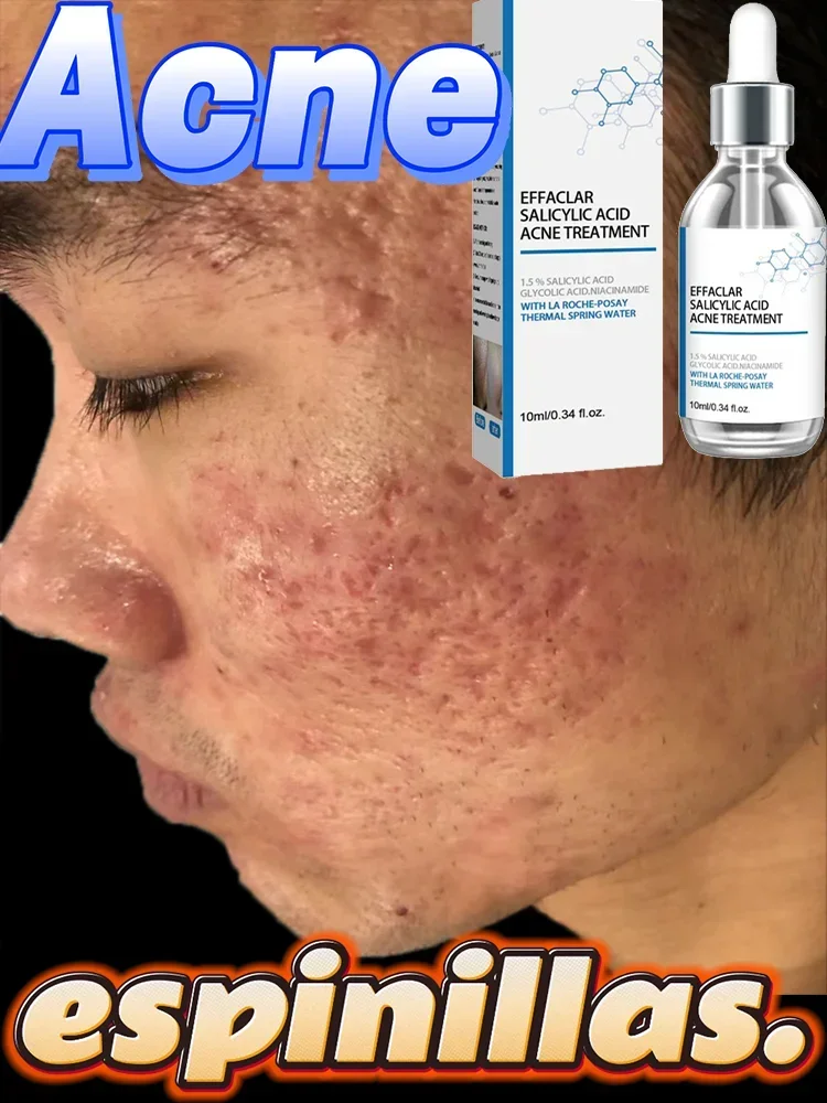 

38Skincare Acne products, professional formula, soothe acne, restore healthy skin shine. Cream