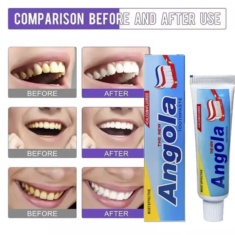 Remover Dental Calculus Whitening TeethMouth Odor Removal Bad Breath Preventing Periodontitis