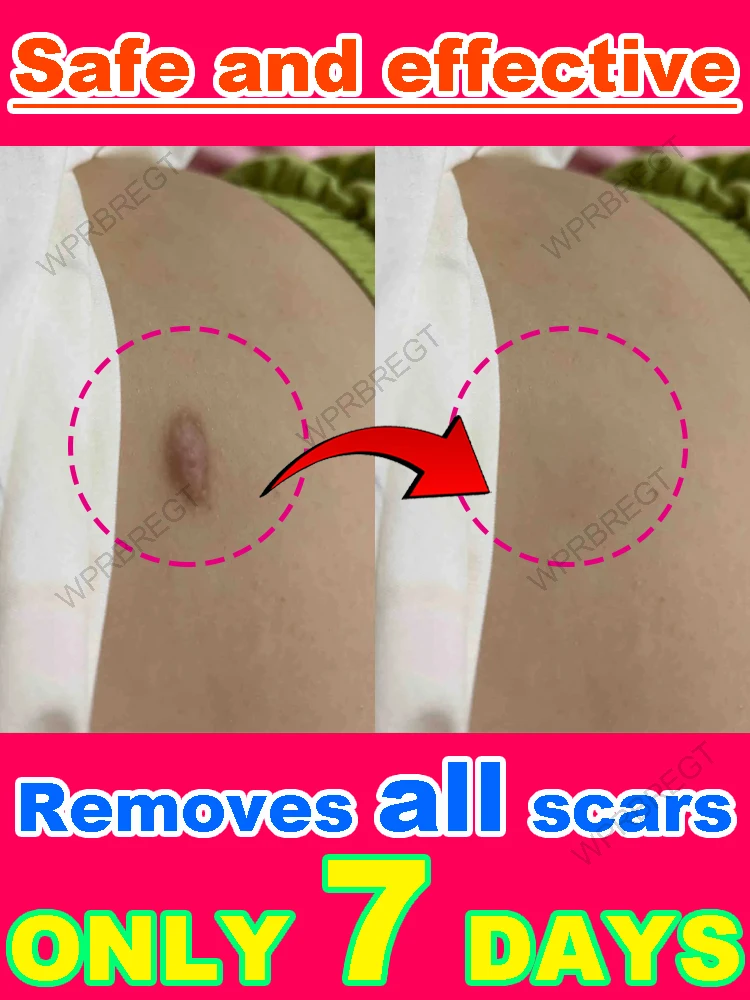 Bespaar huiduitdaging, vlekken verdwijnen!