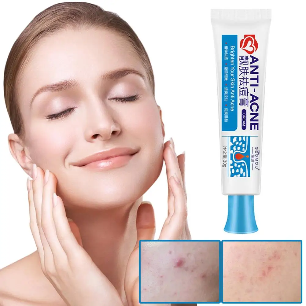 30G Krachtige Acne Verwijdering Gezichtscrème Cleares Puistje Black Traktatie Krimphuid Ernstige Zalf Gel Acne Zorg Litteken Pore Whiteen D O9o8