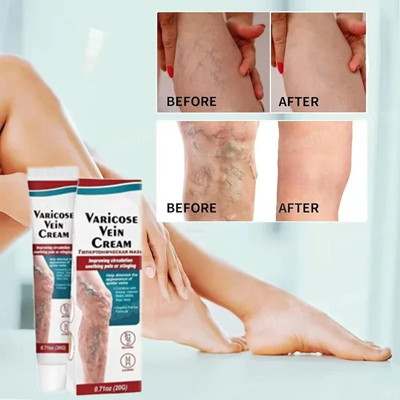 Vein Defense Health Cream helps improve the appearance of spider veins, damaged capillaries, redness