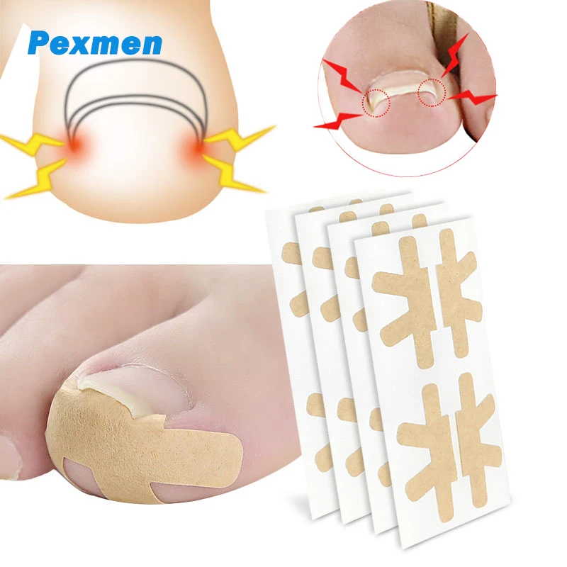 

Pexmen 4/8/20Pcs Ingrown Toenail Correction Sticker Adhesive Toenail Patch Elastic Nail Treatment Corrector Pedicure Tools