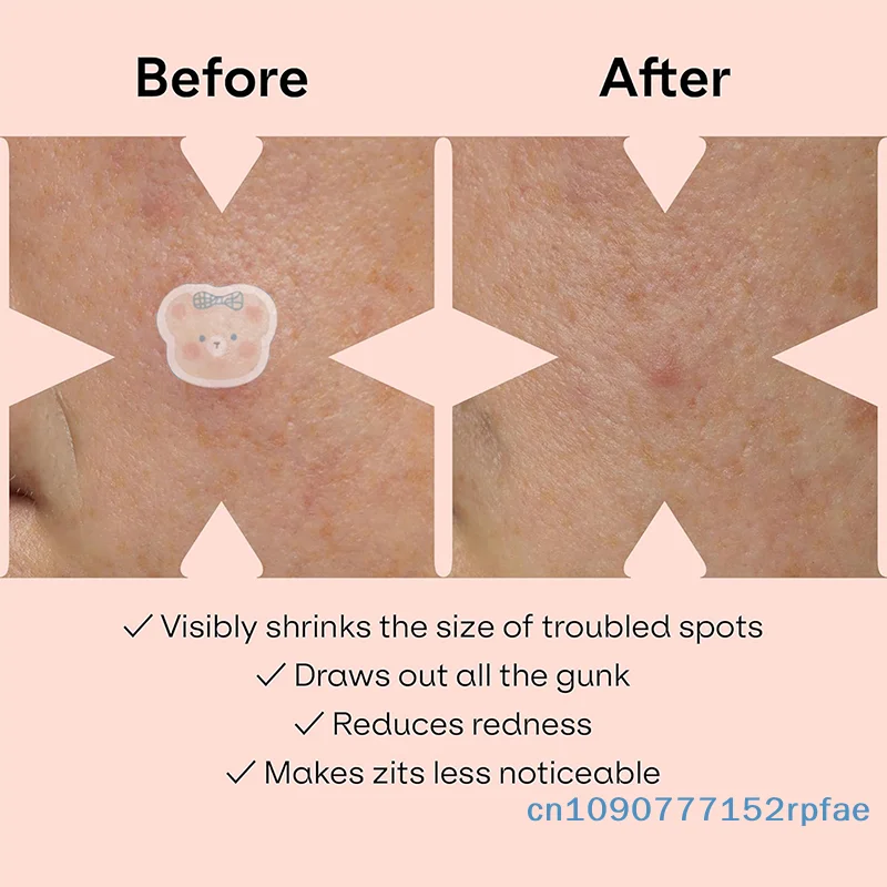 100 قطعة من رقعة بثرة حب الشباب للعناية ببشرة الوجه غير مرئية أدوات احترافية للشفاء والعناية ببشرة الوجه #6