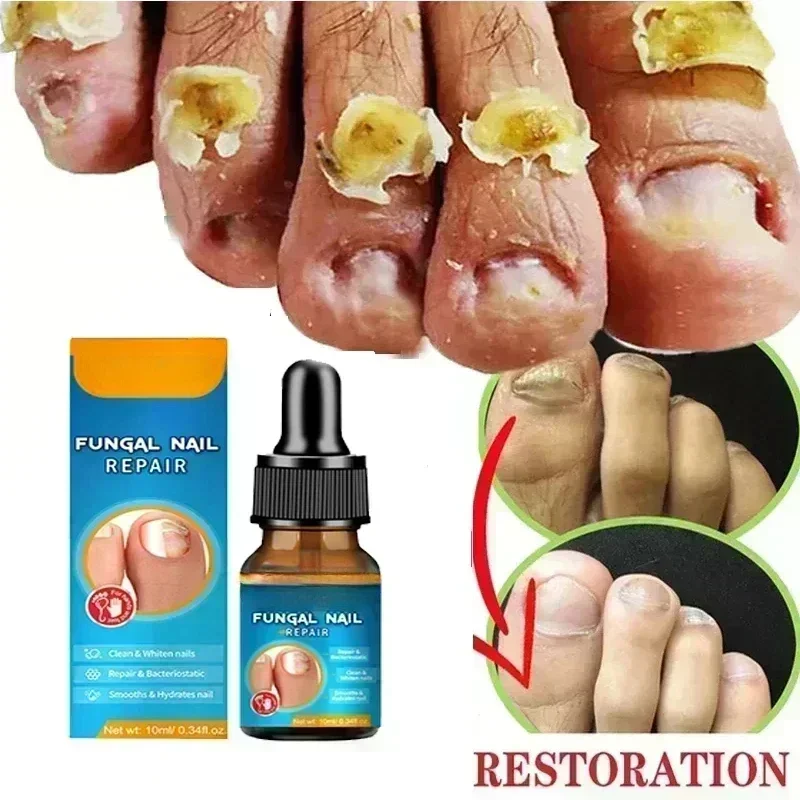 เชื้อราเล็บ Treatment Serum Toe Fungal Repair ผลิตภัณฑ์มือเท้า Care เจลกําจัด Anti Infection Paronychia Onychomycosis