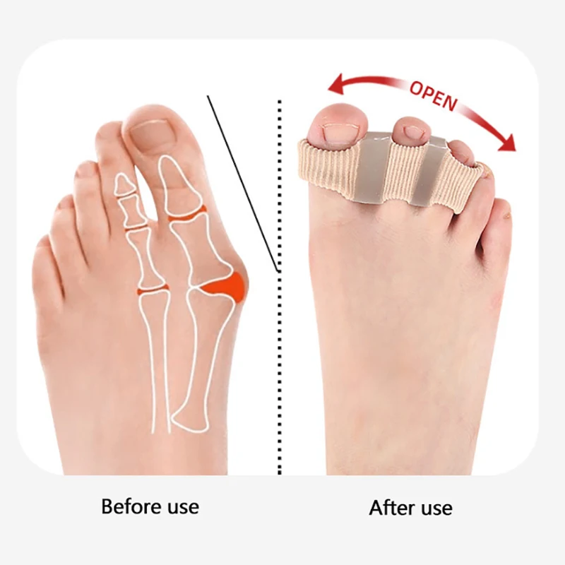 Vijf gaten vezel teen corrector duim valgus drie gaten teen orthopedisch apparaat siliconen gel dubbele ring duim corrector regelaar