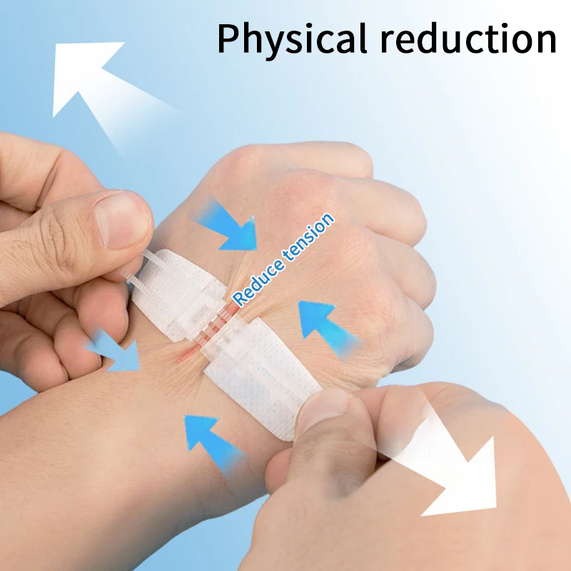 Zíper gravata fechamento de ferida remendo hemostático ferida sutura rápida zíper band-aid ao ar livre ataduras portáteis para cuidados com feridas