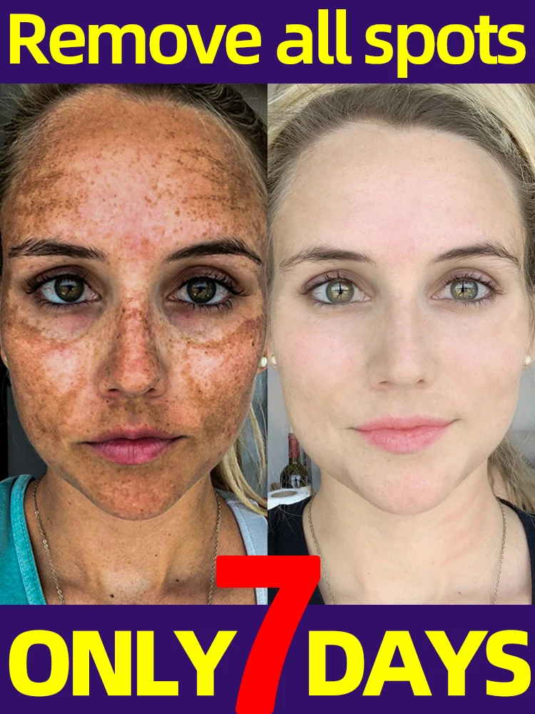 Eliminador de manchas oscuras, pecas, Melasma, cara