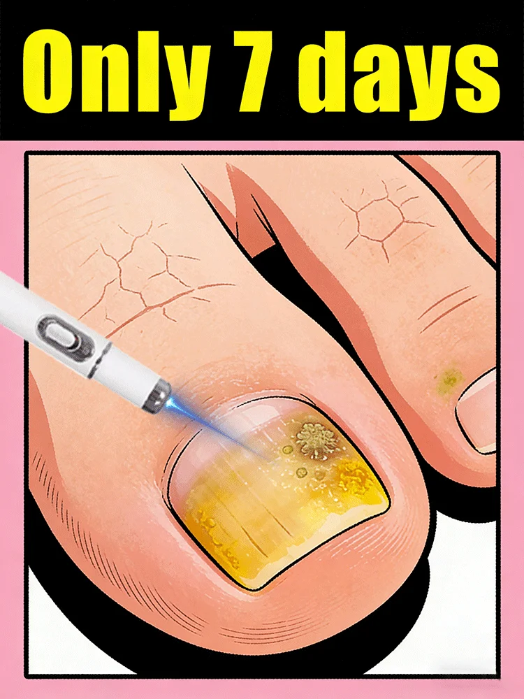 

Лазерная ручка Прибор для лазерной терапии с синим светом для всей семьи, ногтей становится полупрозрачным и без грибка.