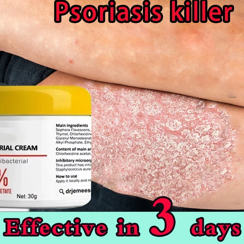 Psoriasis Moisturizing Cream Natural Repair Antibacterial Relieve Exfoliate Dry Skin Itchy Rough Skin Care Moss Removal