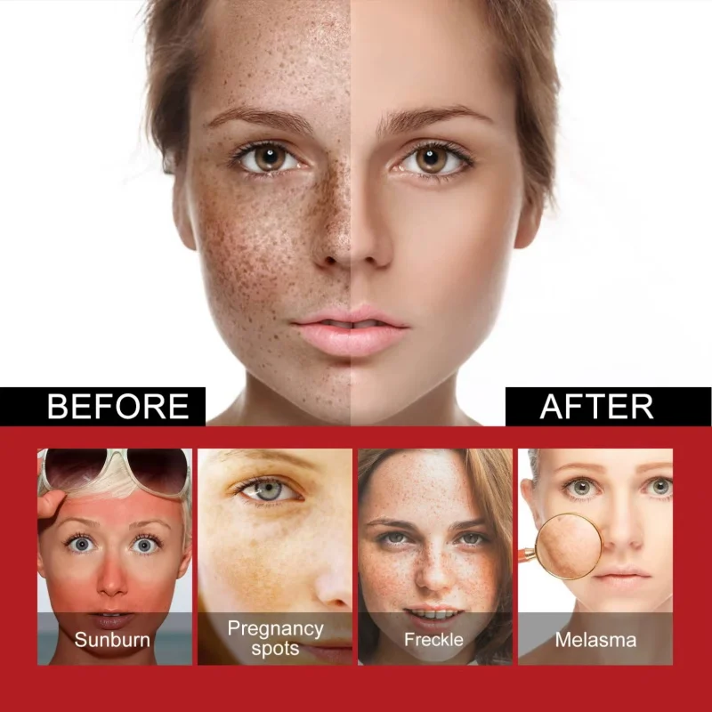 Powerful Spot-Removing Whiten Cream Brighten Skin Fast Eliminates Melanin Pigmentation Melasma Dark Spots Korean Face Skin Care