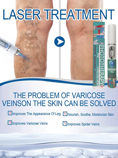 Varicose Veins Laser