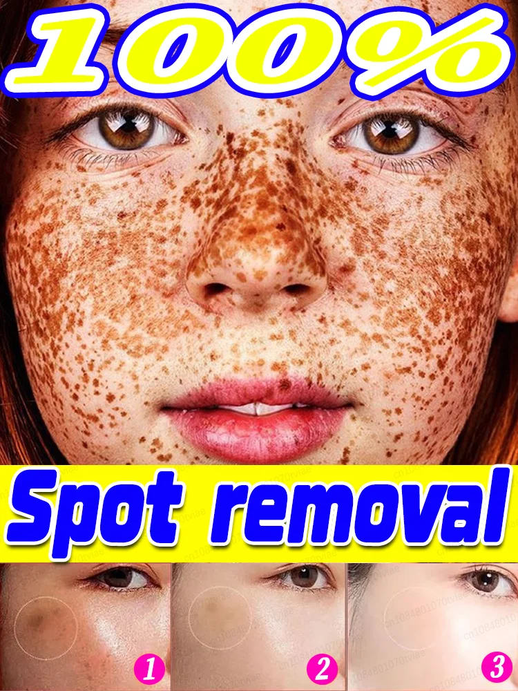 

Fʀᴇᴄᴋʟᴇ Rᴇᴍᴏᴠᴀʟ The pigment magically disappeared, 100% effective skin degeneration, Skin becomes soft