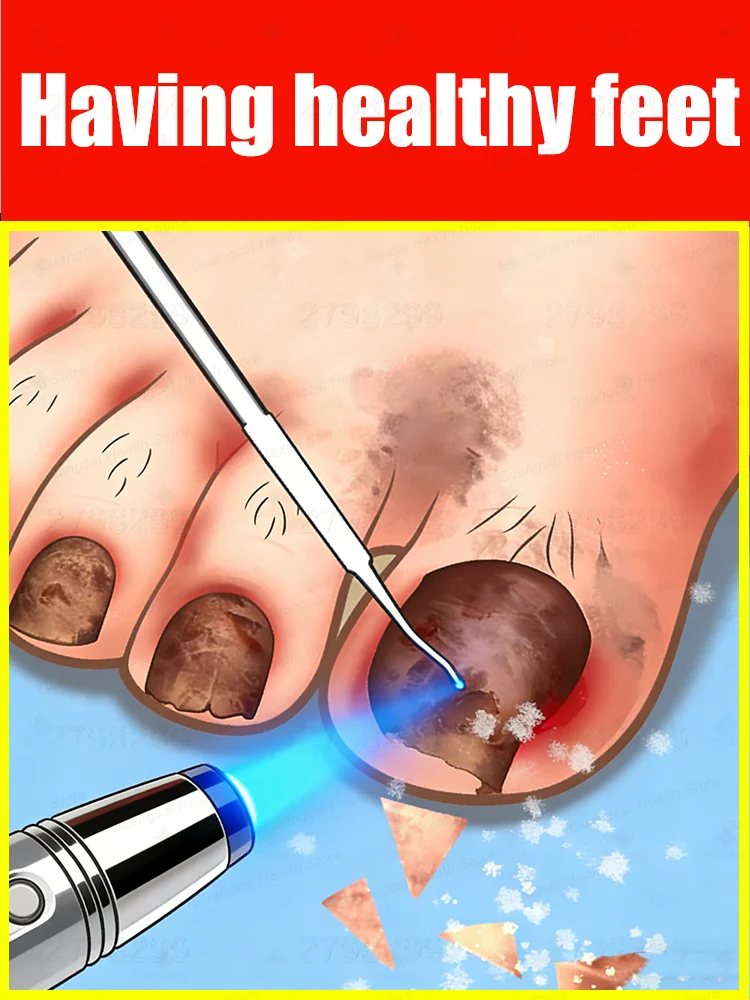 

Blue light laser pen ᵗʰᵒʳᵒᵘᵍʰˡʸ ʳᵉᵐᵒᵛᵉˢ ᶠᵘⁿᵍⁱ⸴ ᑫᵘⁱᶜᵏˡʸ ᵉˡⁱᵐⁱⁿᵃᵗᵉˢ ᶠᵘⁿᵍⁱ⸴and restores nail health.