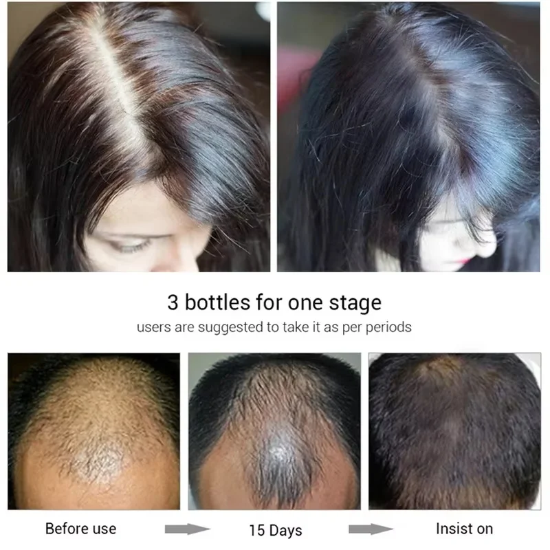 Haarwachstumsserum, 7 Tage schnelles Nachwachsen, ätherisches Kapsel, Anti-Haarausfall, Haarausfall, Reparatur beschädigter Kopfhaut, Behandlung für Frauen und Männer