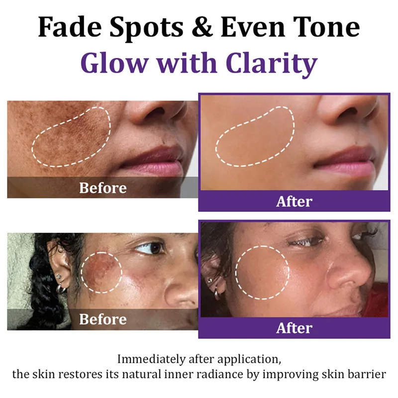 Dark Spots Removal Cream Facial Whitening Freckle Acne Mark Pigmentation Removal Melanin Skin Correction Brighten Care Products - Image 3
