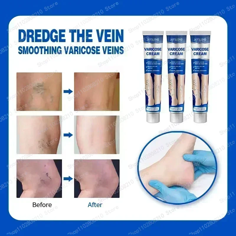 Cream leg skin irritates and soothes venous tension