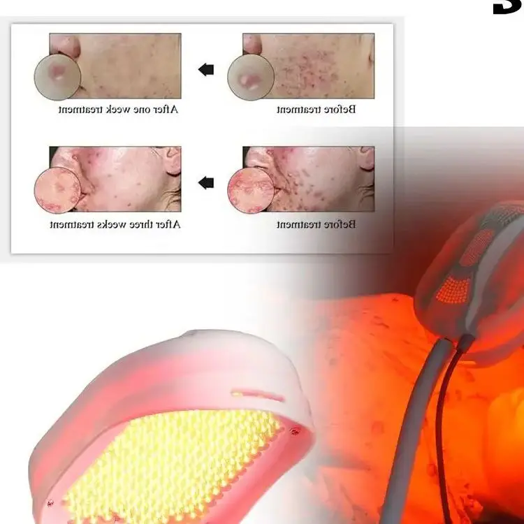 

Multi-Functional LED Therapy Device Red and Blue Color Photon Skin Rejuvenation Device for Psoriasis, Eczema & Acne Treatment