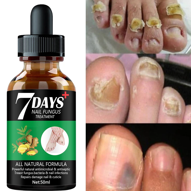 7 Dagen Reparatie Nagel Schimmel Behandelingen Essence Voetverzorging Serum Teen Nagels Schimmelverwijdering Gel Anti-Infectie Onychomycosis(50Ml)