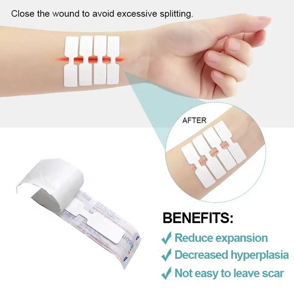 10 pces-100 pces ao ar livre ferida fita adesiva descartável primeiros socorros ferida sutura remendo ferida de emergência rápida sutura remendo
