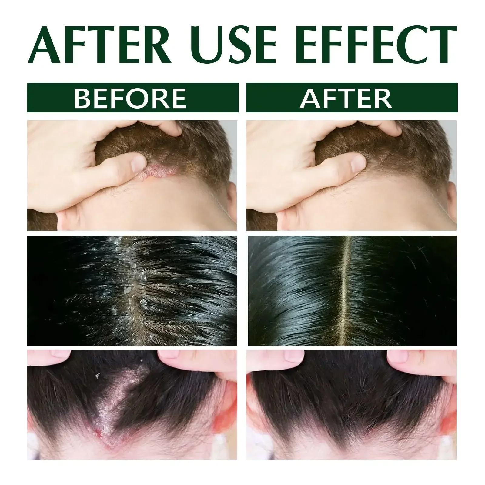 شامبو علاجي علاج مضاد للقشرة حكة فروة الرأس الدهنية شامبو عشبي للعناية بالبشرة للشعر 100 مللي شامبون للنساء #5