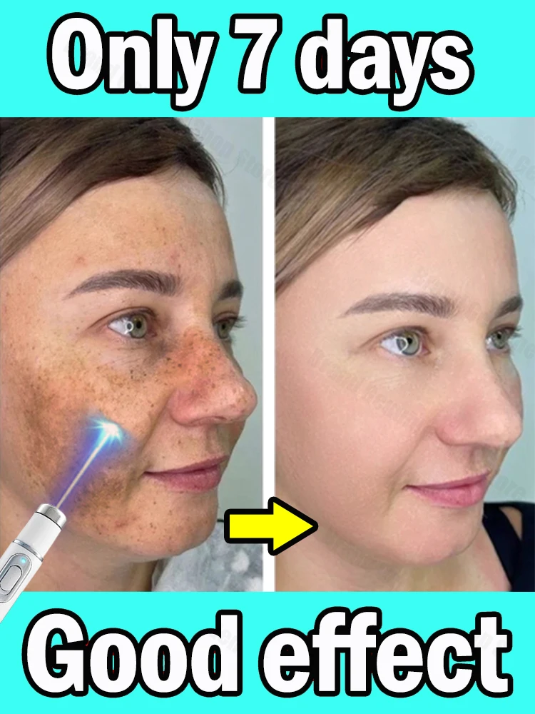 

Facia dark spots disappeared Laser