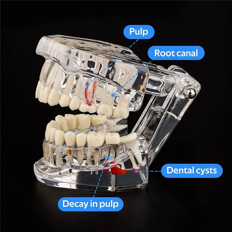 【HOT A71T】 Transparent Disease Teeth Model with Dental Implant Bridge, Dental Model for Patient and Dental Student Education