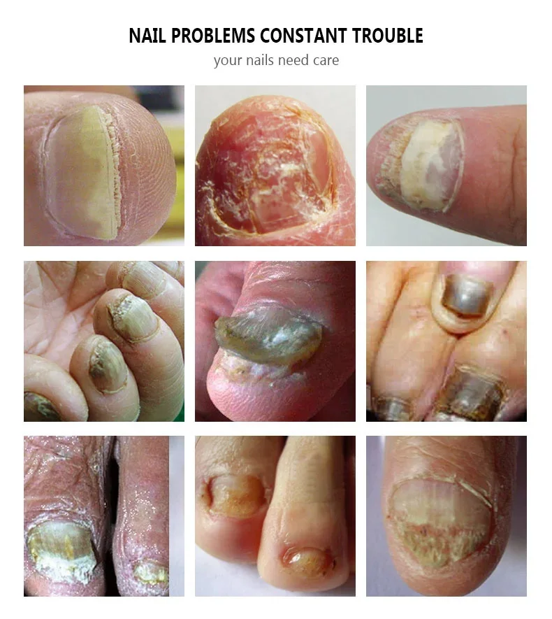 เล็บ Fungal Treatment Serum เท้าเชื้อราเล็บกําจัดน้ํามันหอมระเหย Anti Infection Onychomycosis Paronychia Repairing Care