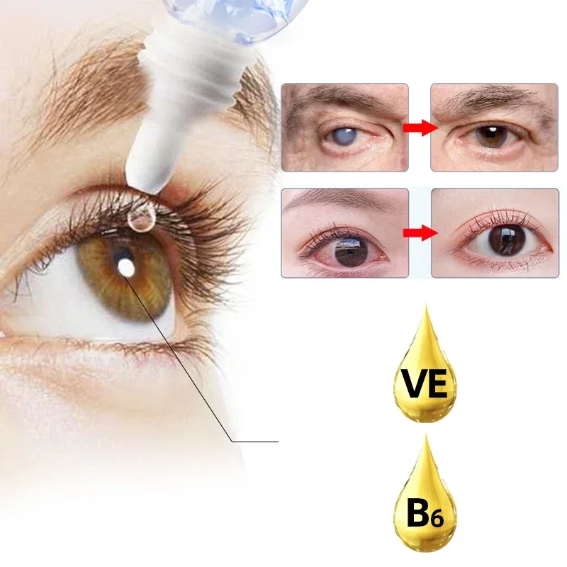 Gouttes oculaires médicales pour le traitement de la cataracte, appliquer à la vision floue, chevauchement de l'ombre noire, globe oculaire nuageux, approuvé par la Cfda, dieux vitaminés, E